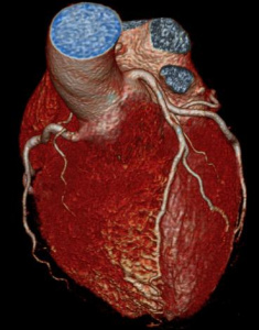 Beispiel einer 3D Rekonstruktion einer Herz CT Untersuchung zur nicht invasiven Darstellung der Koronararterien. Im vorliegenden Beispiel zeigt sich keine Engstelle der Koronararterien.