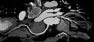 Darstellung der Herzkranzgefäße mittels Herz-CT Untersuchung