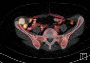PET-CT Untersuchungsbild - Bauchmetastase auf Höhe des Beckeneingangs