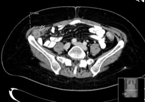 PET-CT Untersuchungsbild - herkömmliche CT